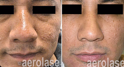 Before and after image:  skin rejuvenation