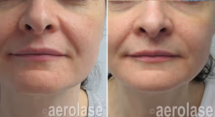 Before and after image:  skin rejuvenation
