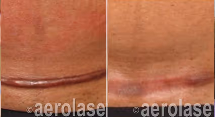 Before and after image:  surgical scar