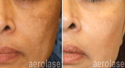 Before and after image: melasma
