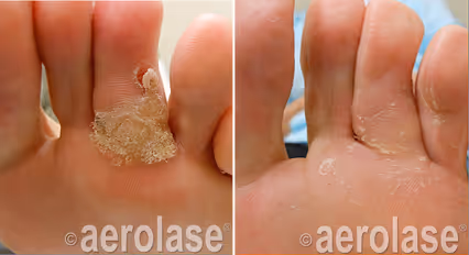 Before and after image: wart on toes
