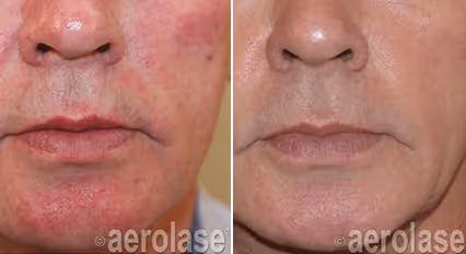 Before and after image: rosacea
