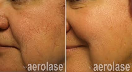 Before and after image: Spider vein