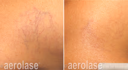 Before and after image: spider vein