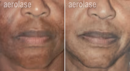 Before and after image: Melasma on a dark skin