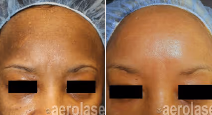 Before and after image: melasma on dark skin
