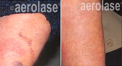 Before and after image: psoriasis