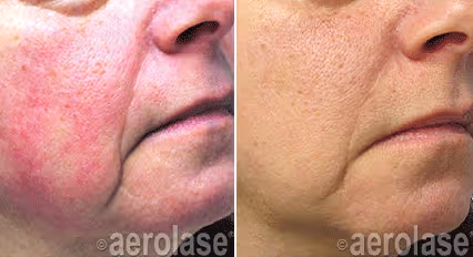 Before and after image: rosacea
