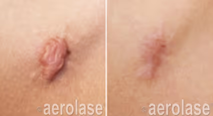Before and after image: surgical scar
