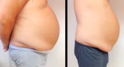 Emerald Laser fat loss before and after