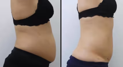 Emerald Laser fat loss before and after