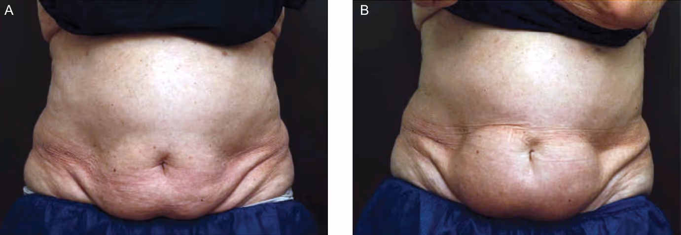 A-Before cryolipolysis; B-5 months after. Image credit: N.Stroumza et al, published in Aesthetic Surgery Journal.