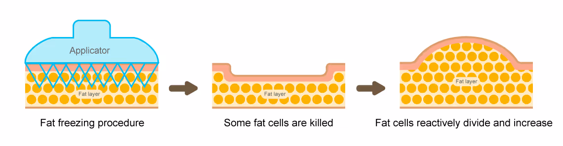 Other fat loss treatment, especially fat freezing treatments can lead to unwanted extra fat cell growth in treated areas