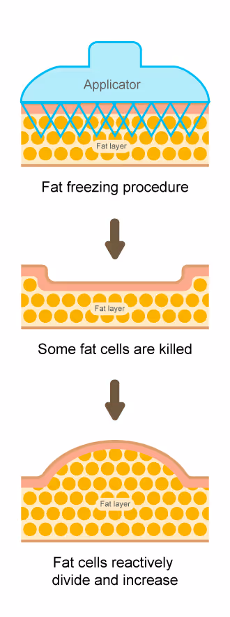 Other fat loss treatment, especially fat freezing treatments can lead to unwanted extra fat cell growth in treated areas