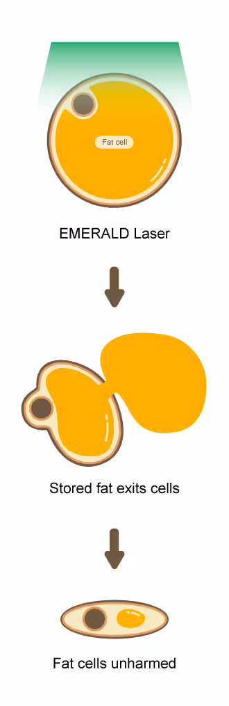Diagram of emerald laser making the fat cell push its content out and remain unharmed