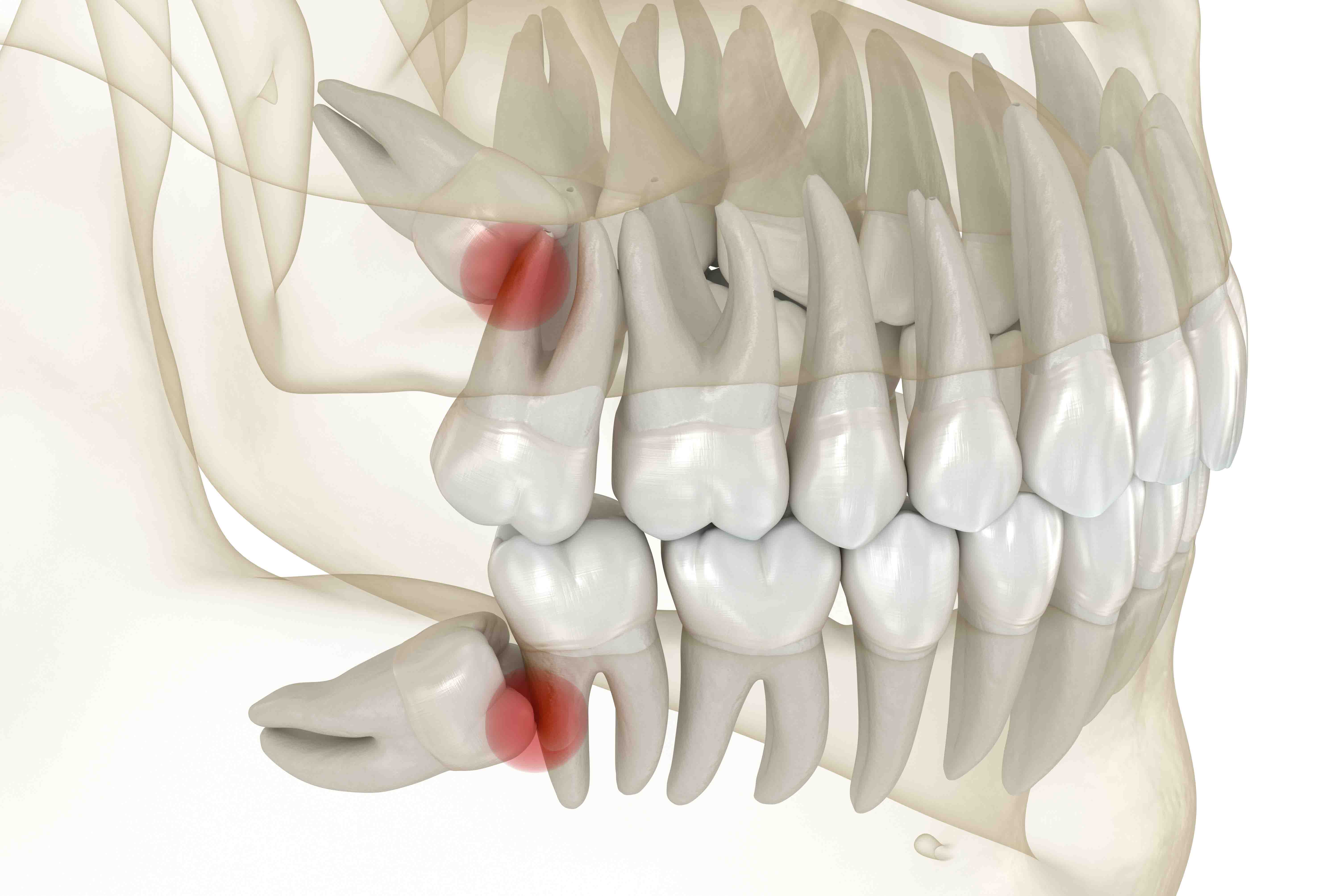 Tooth Extraction Process
