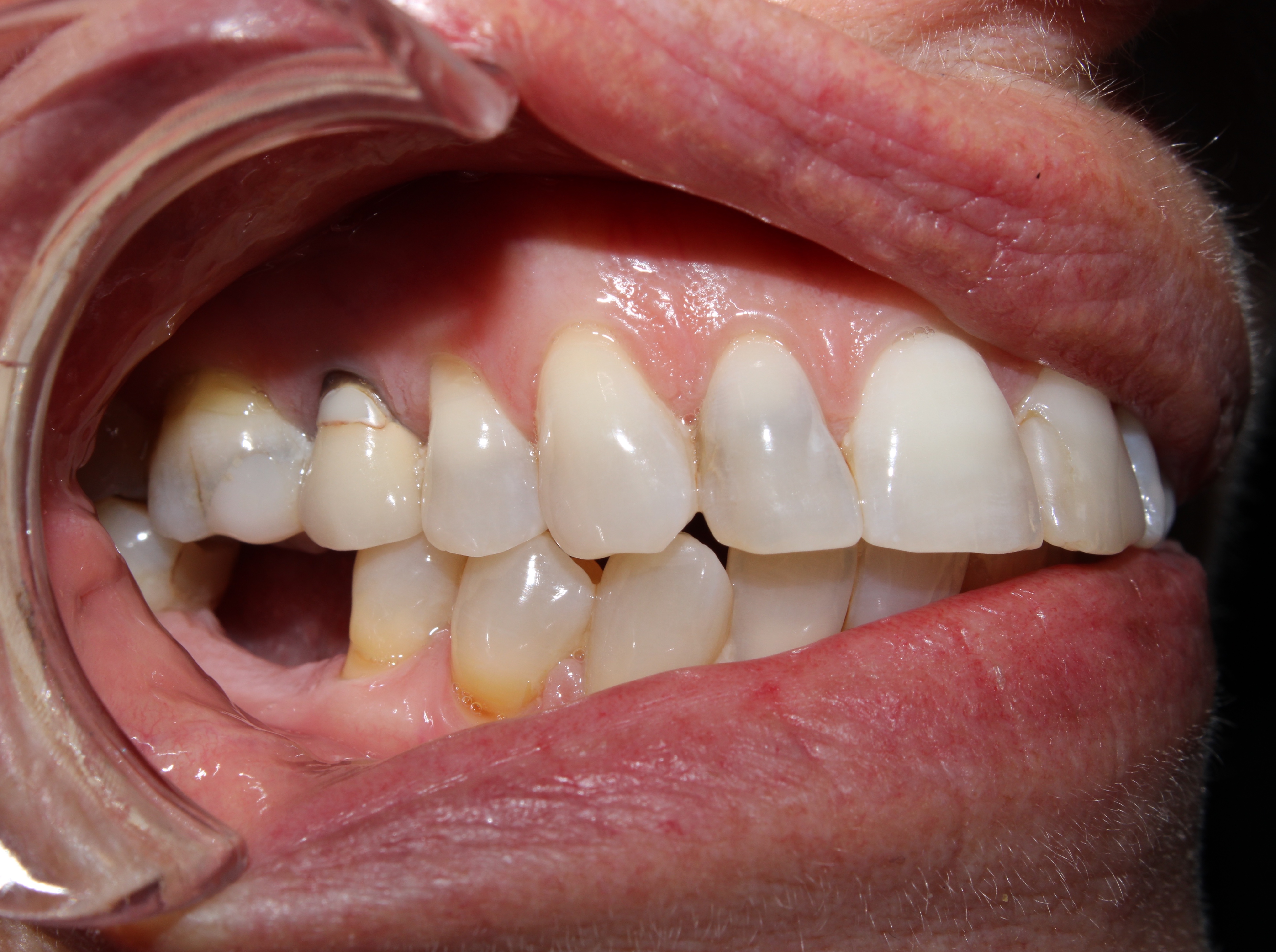 Case 02 before treatment