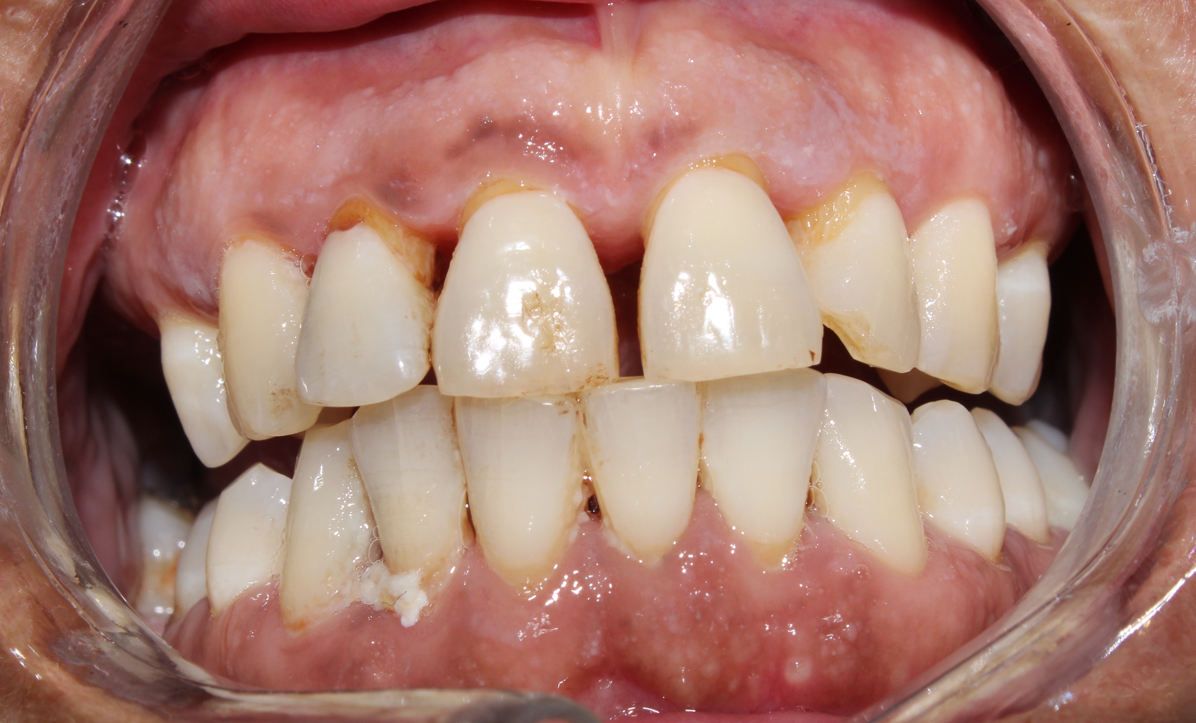 Case 03 before treatment