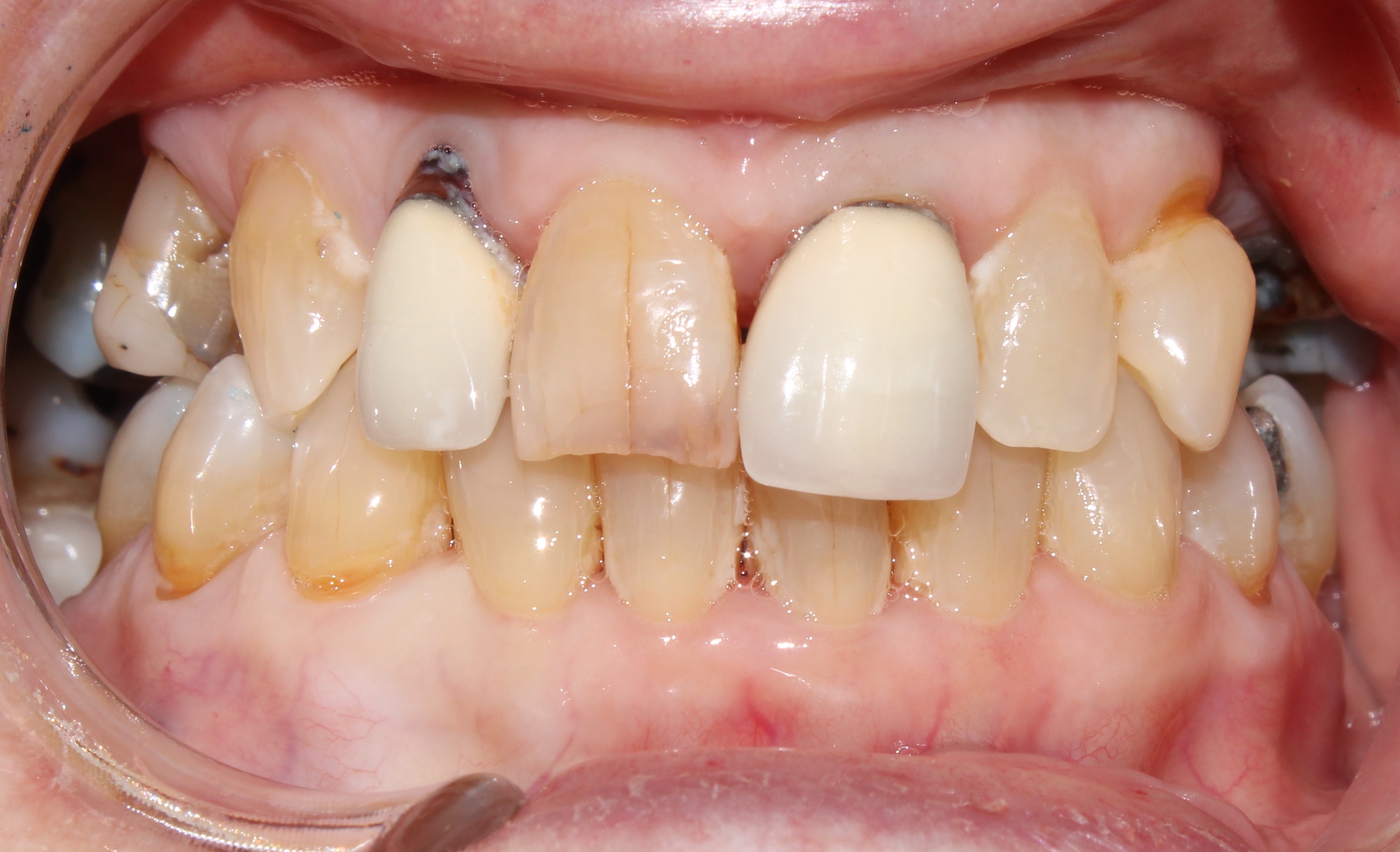 Case 04 before treatment