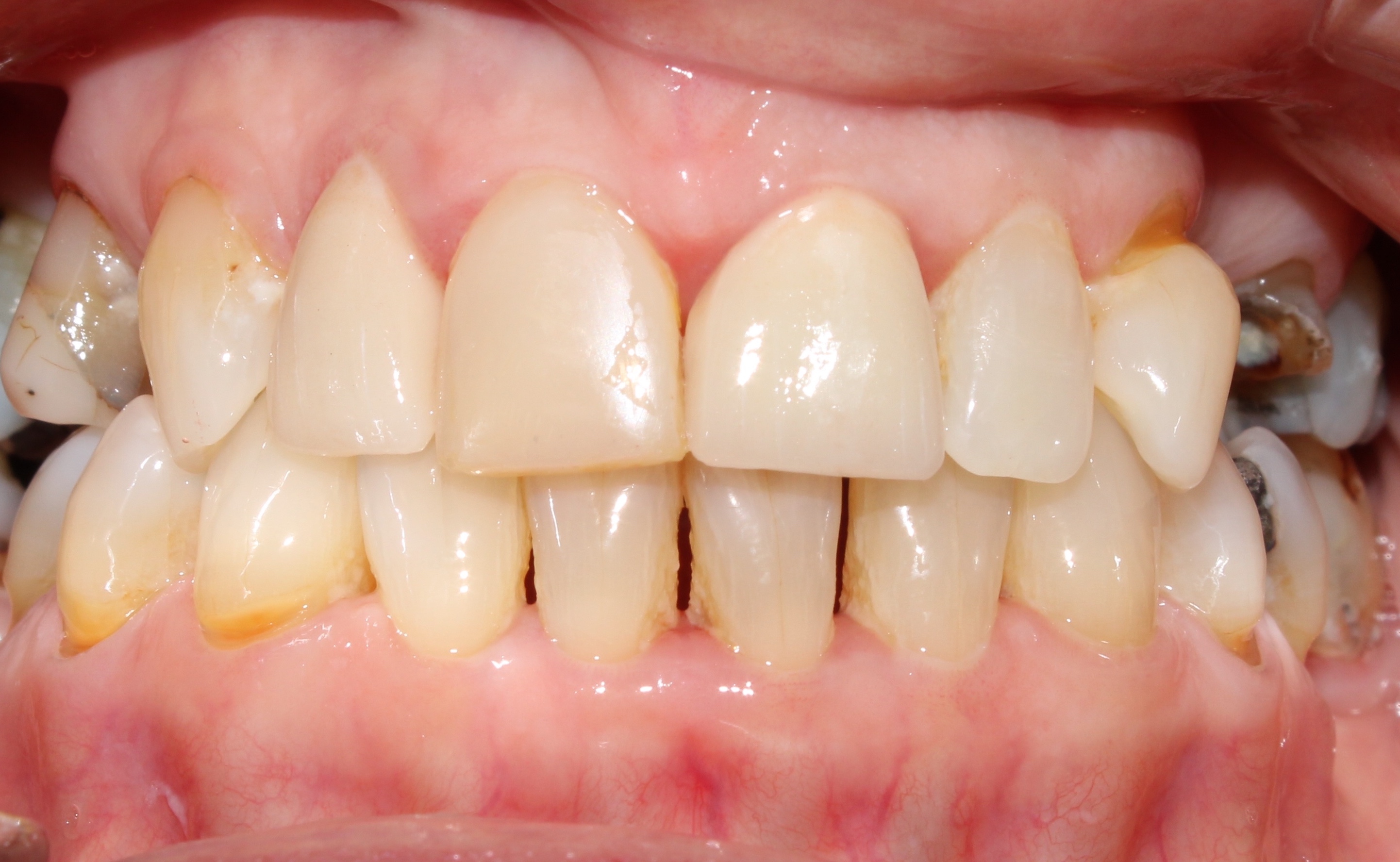 Case 04 after treatment