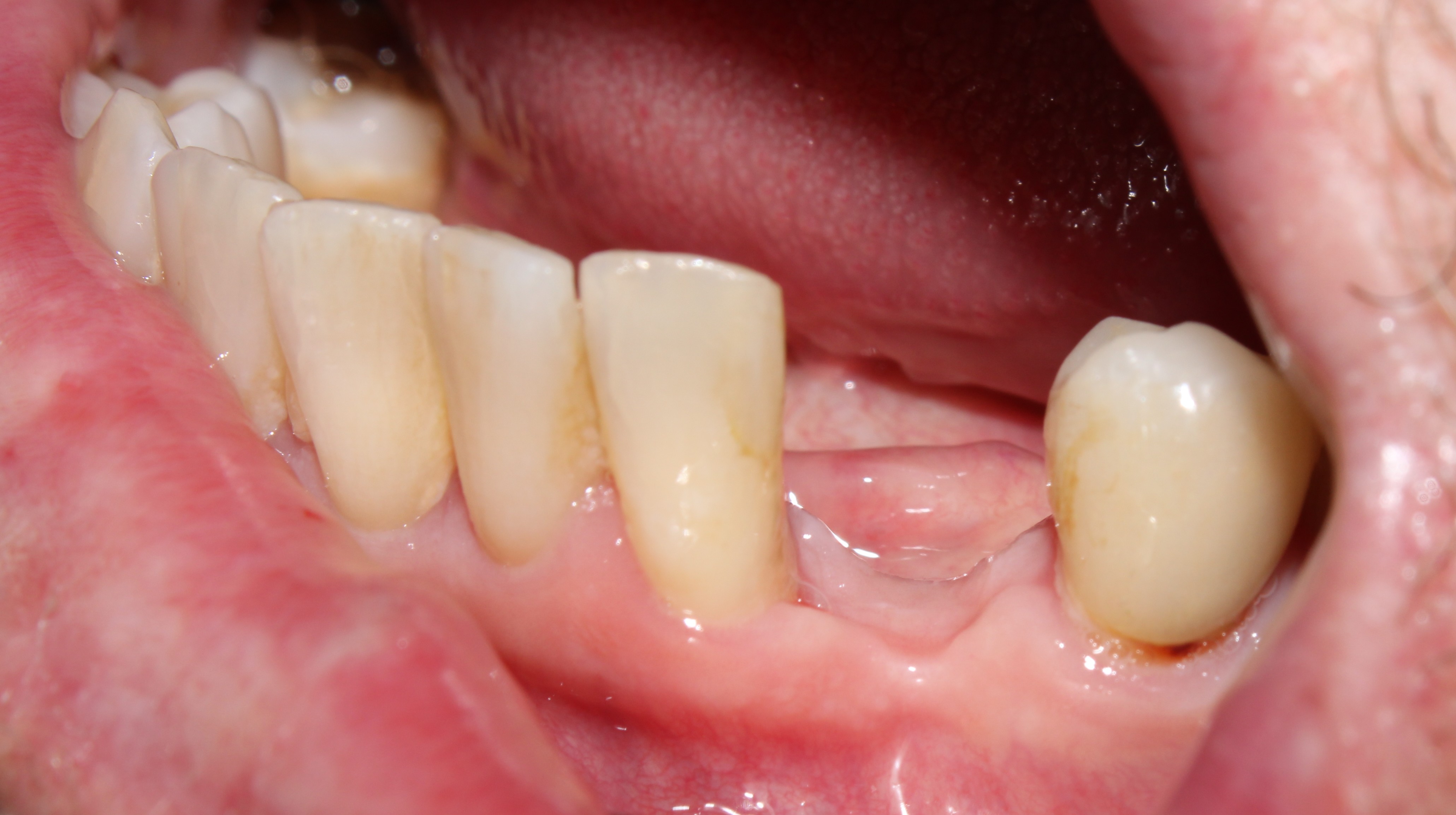 Case 03 before treatment