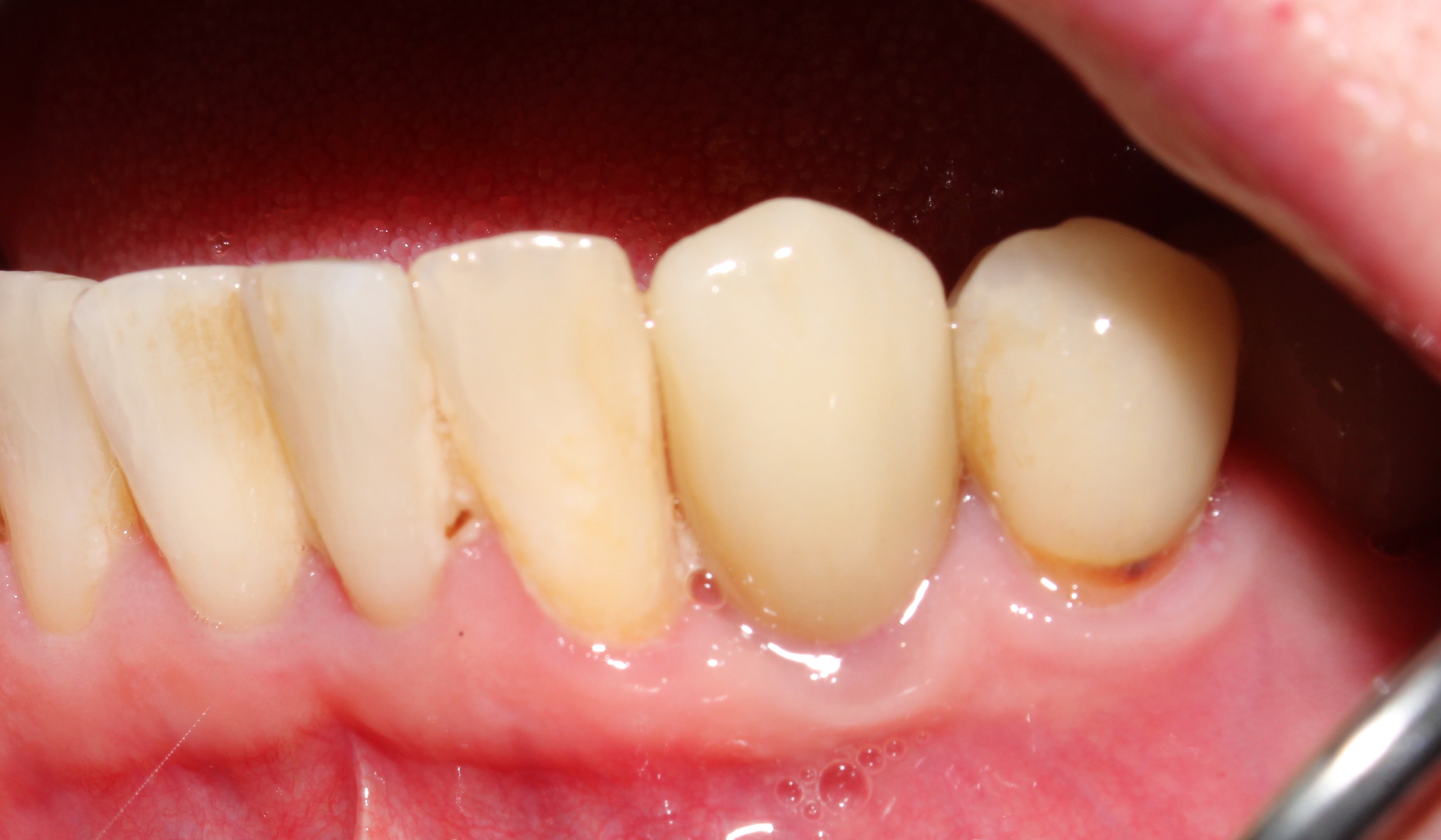 Case 03 after treatment