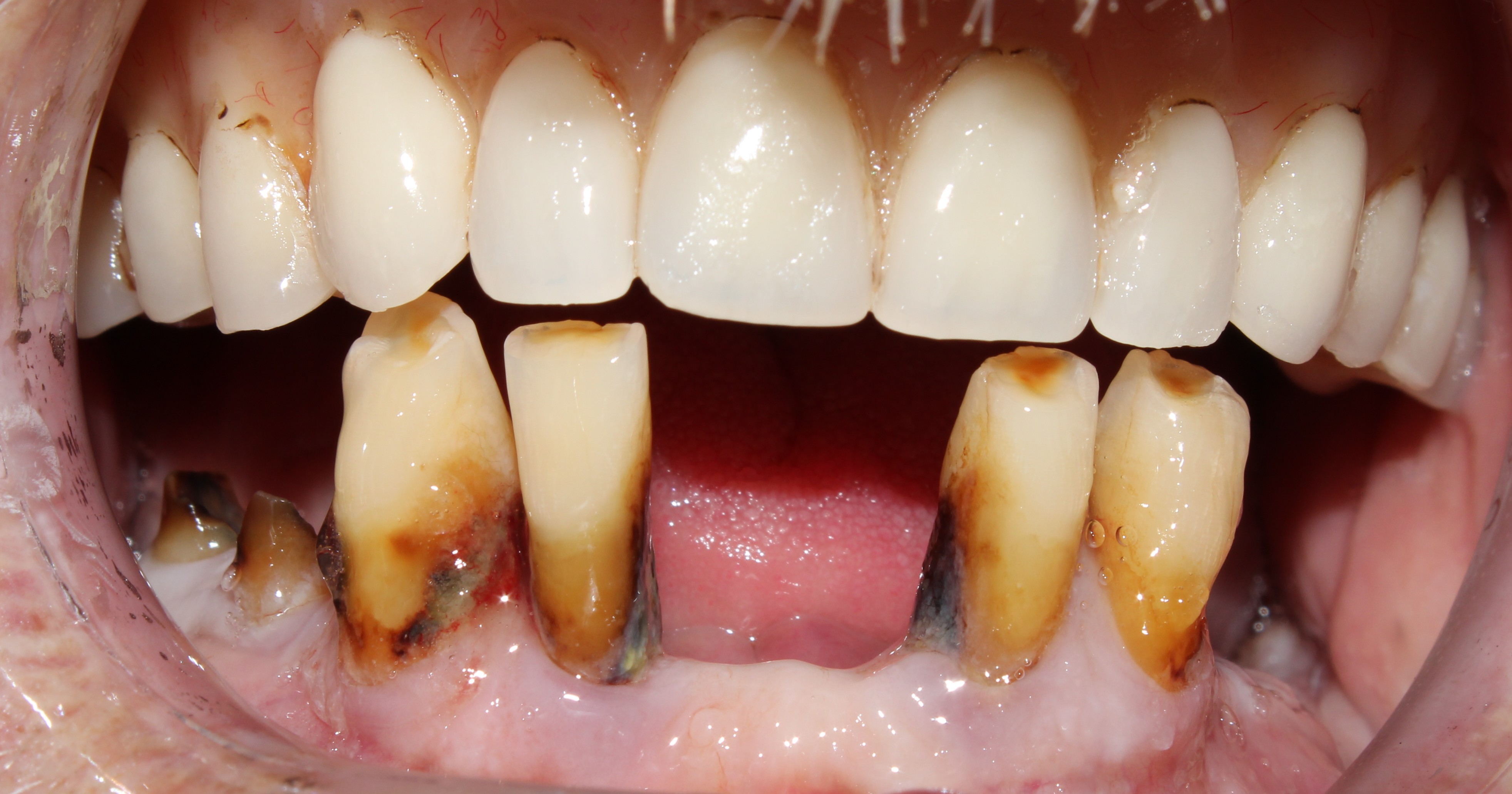 Case 04 before treatment