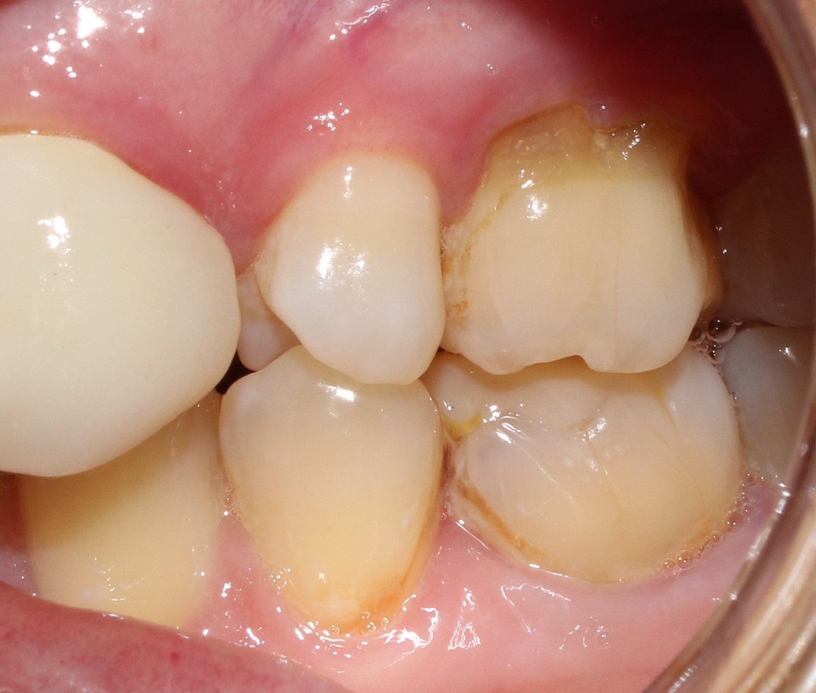 Case 06 before treatment