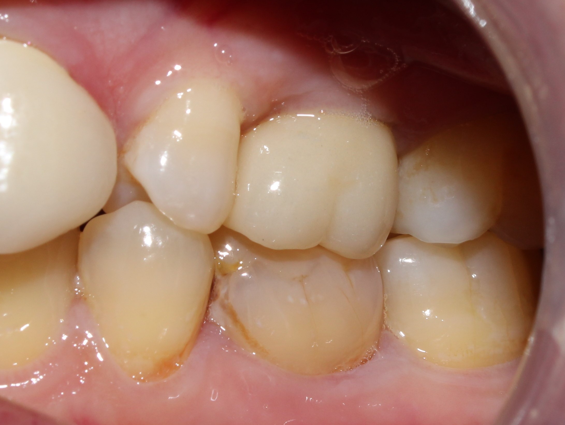 Case 06 after treatment
