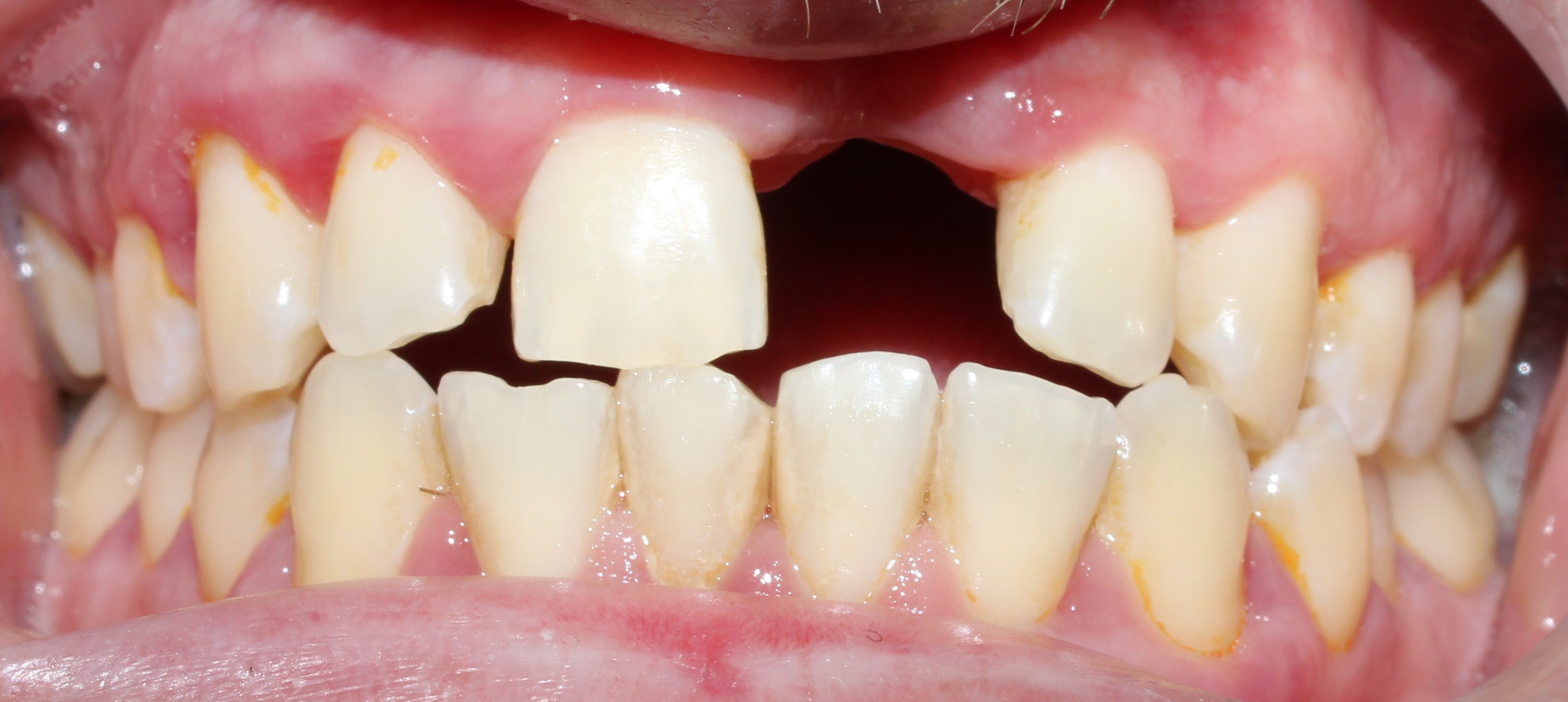 Case 03 before treatment