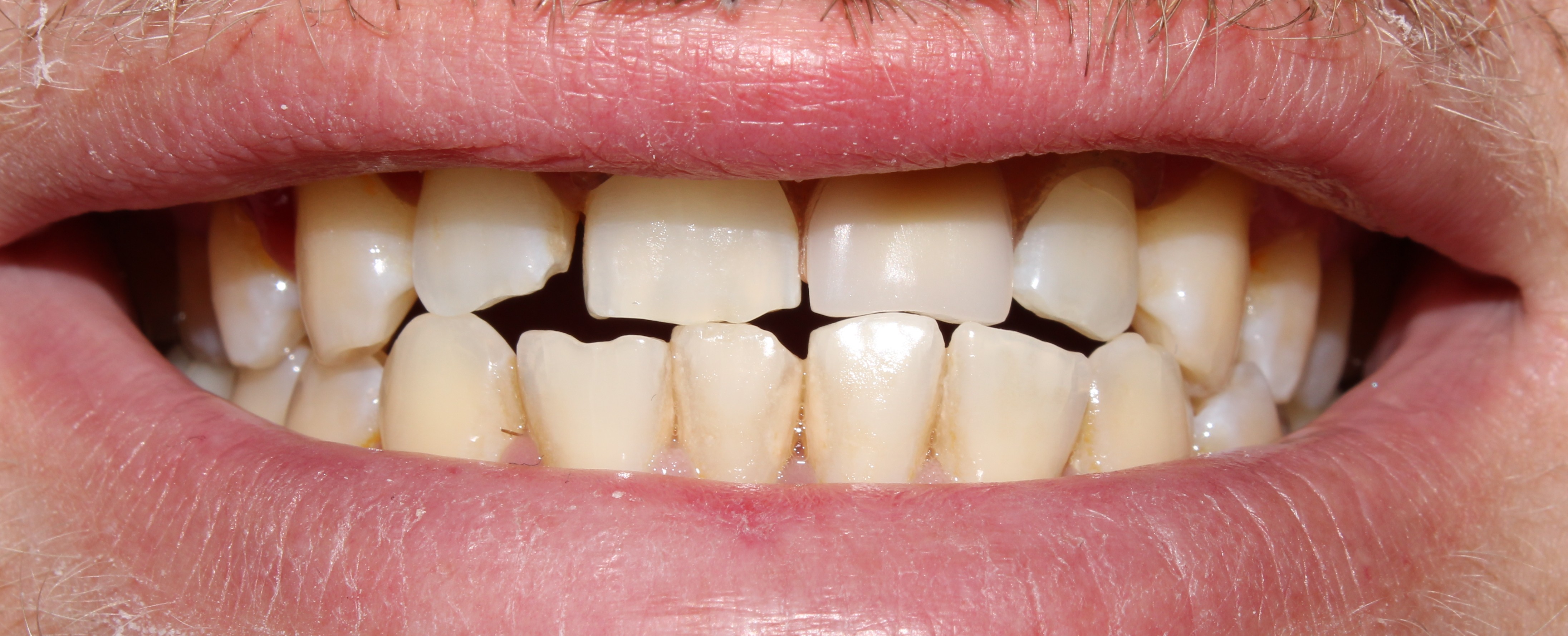Case 03 after treatment
