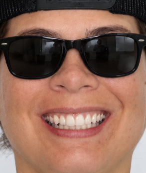 Smile-006