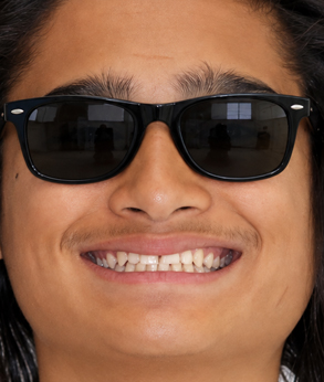 Smile-007