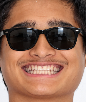 Smile-007