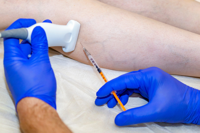 How to Prevent Spider Veins From Appearing or Reappearing