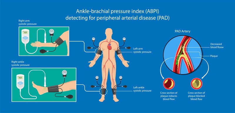 The Importance of Regular Vascular Screenings