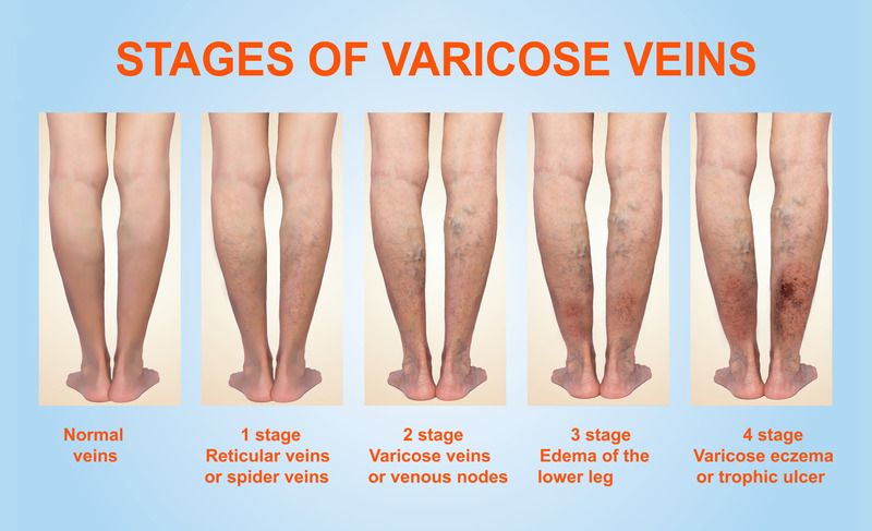 What Are the Signs You Should Visit a Varicose Vein Specialist?