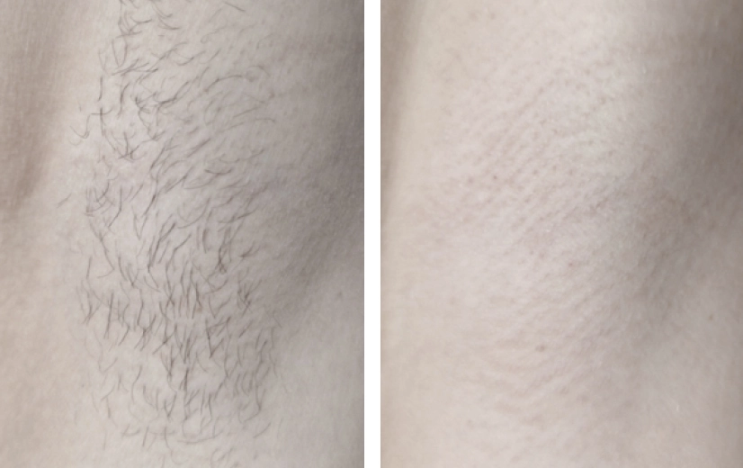 Voor en na resultaat van 4 keer behandelen van de oksel, van stoppels naar gladde huid. 