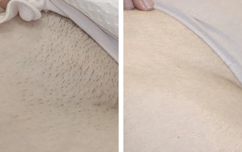 Voor en na resultaat van 4 keer behandelen van de schaamstreek, van stoppels naar gladde huid. 