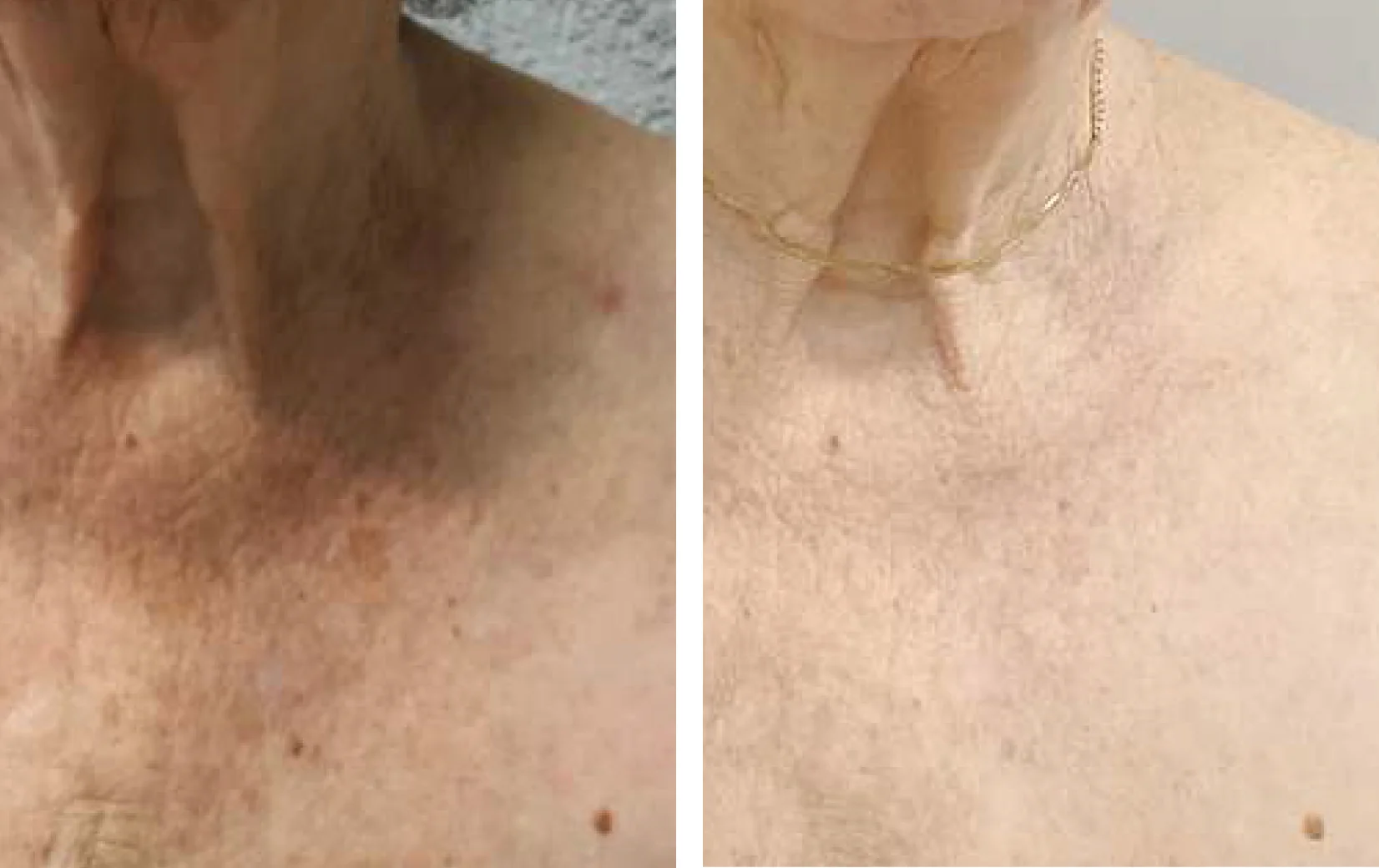 Voor en na resultaat van 4 keer behandelen van de schaamstreek, van stoppels naar gladde huid.