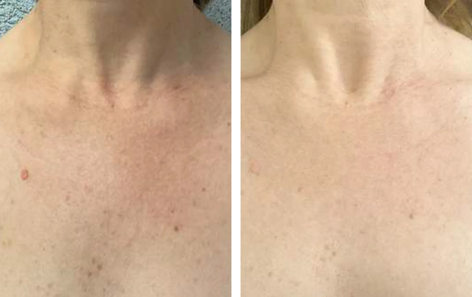 Voor en na resultaat van 4 keer behandelen van de schaamstreek, van stoppels naar gladde huid.