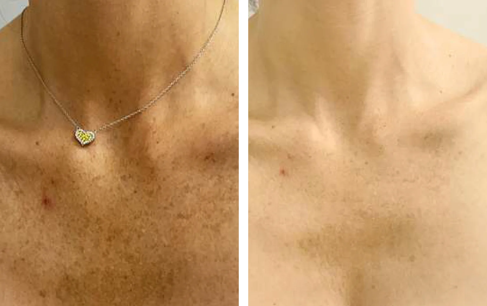 Voor en na resultaat van 4 keer behandelen van de schaamstreek, van stoppels naar gladde huid.