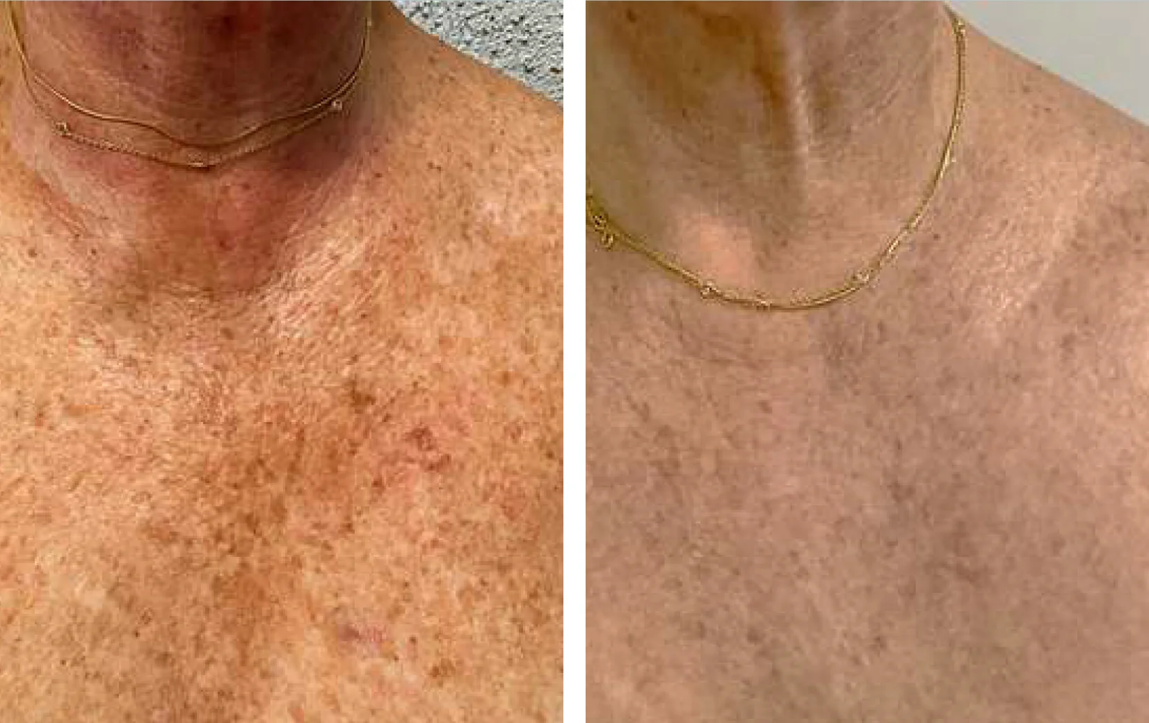 Voor en na resultaat van 4 keer behandelen van de schaamstreek, van stoppels naar gladde huid.