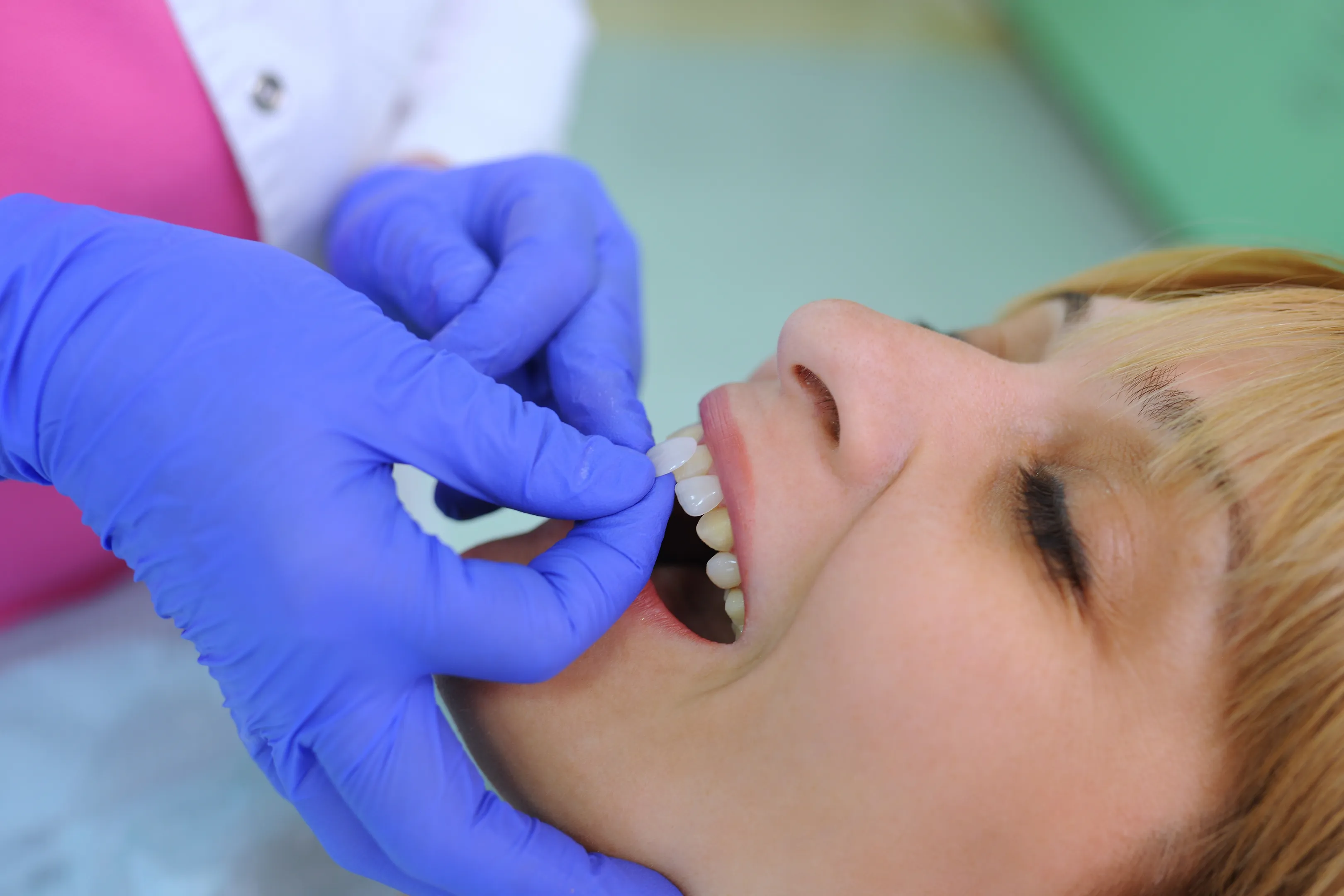 Neer Veneers