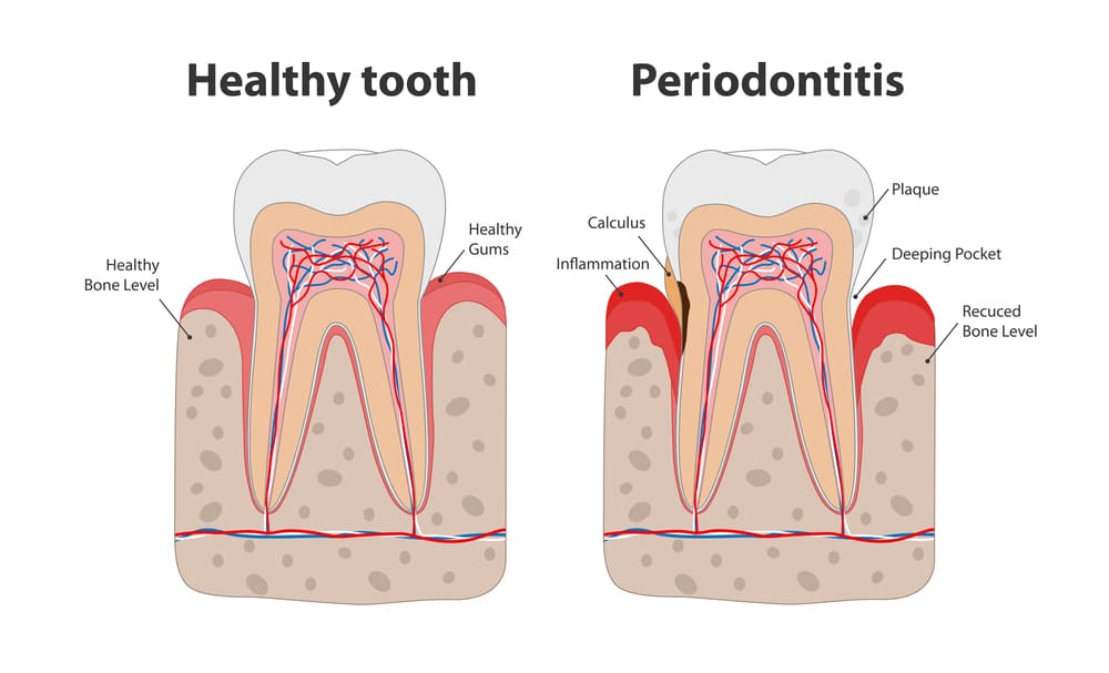 about periodontitis