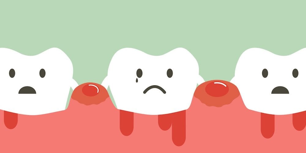 how to heal bleeding gum