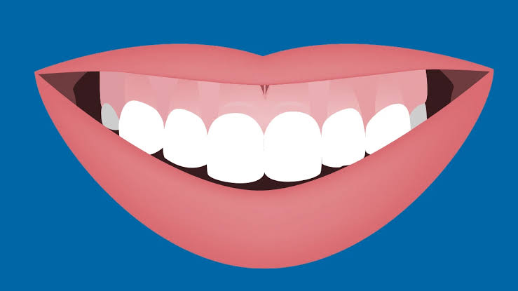 Image of a gummy smile