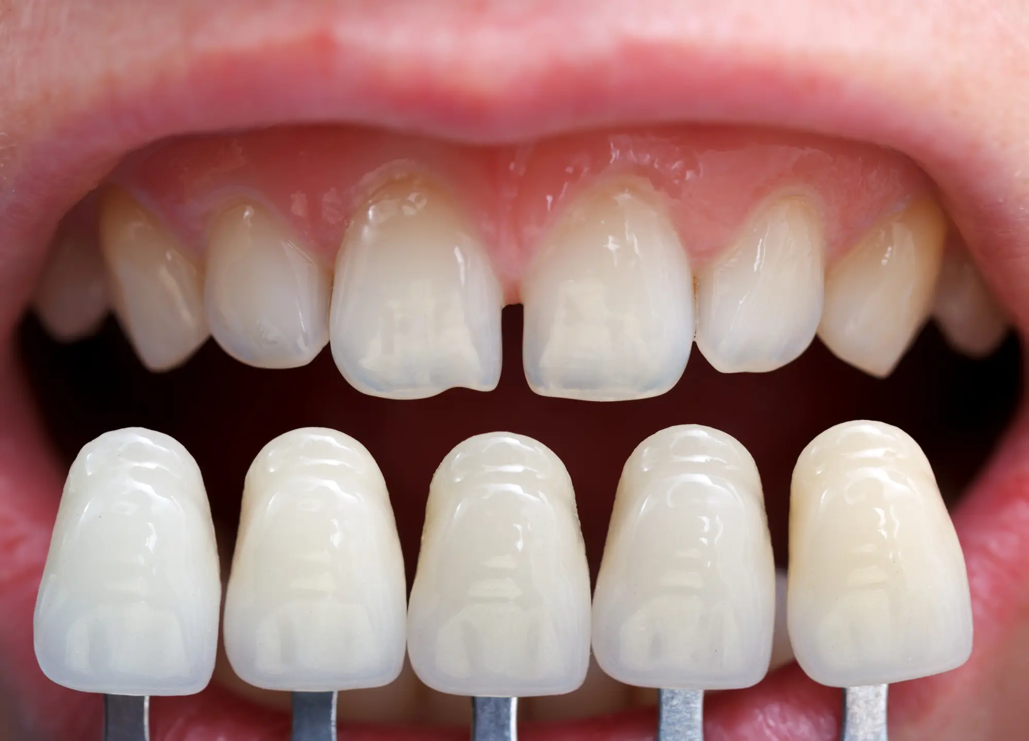 Correcting Chips, Gaps, and Stains with Veneers in Forest Grove