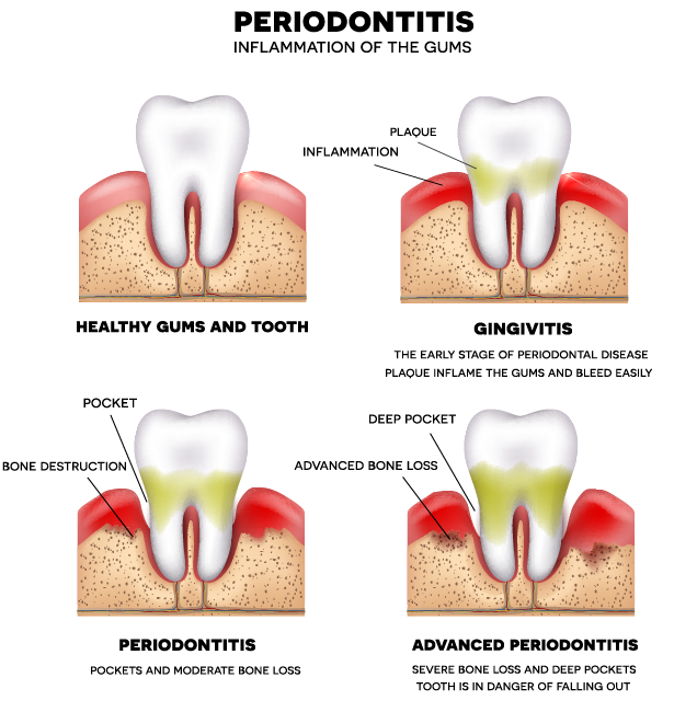 Deep Teeth Cleaning service at Houston Dental Oasis in Houston Heights, TX