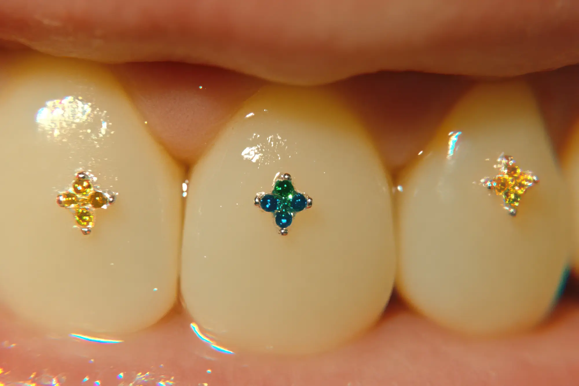 Safe Tooth Gem Removal in Eugene, OR | Hudson Dental